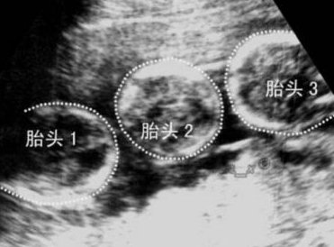 死精率80%的男性可以在枝江市做三代试管吗？公开2026做三代试管条件